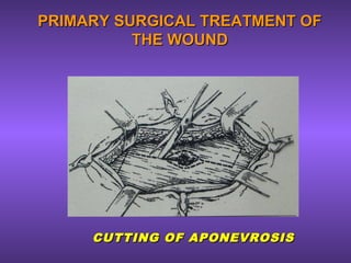 PRIMARY SURGICAL TREATMENT OFPRIMARY SURGICAL TREATMENT OF
THE WOUNDTHE WOUND
CUTTING OF APONEVROSISCUTTING OF APONEVROSIS
 