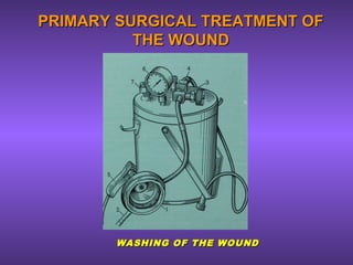 PRIMARY SURGICAL TREATMENT OFPRIMARY SURGICAL TREATMENT OF
THE WOUNDTHE WOUND
WASHING OF THE WOUNDWASHING OF THE WOUND
 