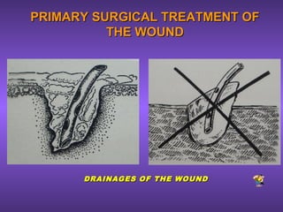 PRIMARY SURGICAL TREATMENT OFPRIMARY SURGICAL TREATMENT OF
THE WOUNDTHE WOUND
DRAINAGES OF THE WOUNDDRAINAGES OF THE WOUND
 
