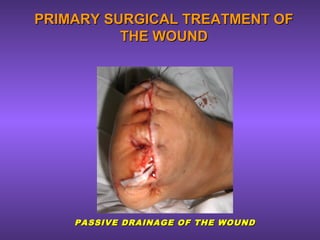 PRIMARY SURGICAL TREATMENT OFPRIMARY SURGICAL TREATMENT OF
THE WOUNDTHE WOUND
PASSIVE DRAINAGE OF THE WOUNDPASSIVE DRAINAGE OF THE WOUND
 