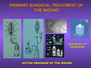 PRIMARY SURGICAL TREATMENT OFPRIMARY SURGICAL TREATMENT OF
THE WOUNDTHE WOUND
ACTIVE DRAINAGE OF THE WOUNDACTIVE DRAINAGE OF THE WOUND
REDONS SET OFREDONS SET OF
DRAINAGINGDRAINAGING
 