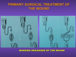 PRIMARY SURGICAL TREATMENT OFPRIMARY SURGICAL TREATMENT OF
THE WOUNDTHE WOUND
WASHING DRAINAGES OF THE WOUNDWASHING DRAINAGES OF THE WOUND
 