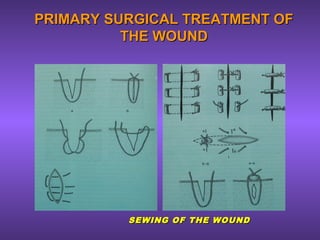PRIMARY SURGICAL TREATMENT OFPRIMARY SURGICAL TREATMENT OF
THE WOUNDTHE WOUND
SEWING OF THE WOUNDSEWING OF THE WOUND
 