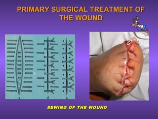 PRIMARY SURGICAL TREATMENT OFPRIMARY SURGICAL TREATMENT OF
THE WOUNDTHE WOUND
SEWING OF THE WOUNDSEWING OF THE WOUND
 