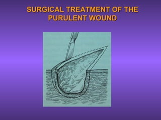 SURGICAL TREATMENT OF THESURGICAL TREATMENT OF THE
PURULENT WOUNDPURULENT WOUND
 