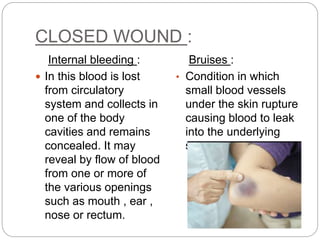 CLOSED WOUND :
Internal bleeding :
 In this blood is lost
from circulatory
system and collects in
one of the body
cavities and remains
concealed. It may
reveal by flow of blood
from one or more of
the various openings
such as mouth , ear ,
nose or rectum.
Bruises :
• Condition in which
small blood vessels
under the skin rupture
causing blood to leak
into the underlying
skin tissue.
 