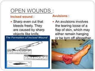 OPEN WOUNDS :
Incised wound : Avulsions :
 Sharp even cut that
bleeds freely. They
are caused by sharp
objects like knife,
razor, blade or broken
glass.
 An avulsions involves
the tearing loose of a
flap of skin, which may
either remain hanging
or be torn off altogether.
 