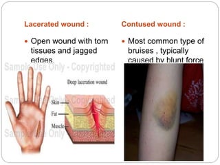 Lacerated wound : Contused wound :
 Open wound with torn
tissues and jagged
edges.
 Most common type of
bruises , typically
caused by blunt force
trauma.
 