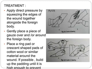 TREATMENT :
• Apply direct pressure by
squeezing the edges of
the wound together
alongside the foreign
body.
• Gently place a piece of
gauze over and /or around
the foreign body.
• Place a ring pad or
crescent shaped pads of
cotton wool or similar
material around the
wound. If possible , build
up the padding until it is
high enough to prevent
 