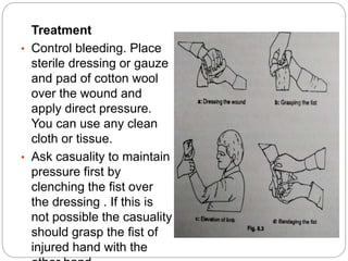 Treatment
• Control bleeding. Place
sterile dressing or gauze
and pad of cotton wool
over the wound and
apply direct pressure.
You can use any clean
cloth or tissue.
• Ask casuality to maintain
pressure first by
clenching the fist over
the dressing . If this is
not possible the casuality
should grasp the fist of
injured hand with the
 