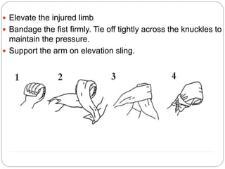  Elevate the injured limb
 Bandage the fist firmly. Tie off tightly across the knuckles to
maintain the pressure.
 Support the arm on elevation sling.
 
