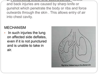 3. Penetrating chest and backwounds :Chest
and back injuries are caused by sharp knife or
gunshot which penetrate the body or ribs and force
outwards through the skin . This allows entry of air
into chest cavity.
MECHANISM
• In such injuries the lung
on affected side deflates,
even if it is not punctured
and is unable to take in
air.
 