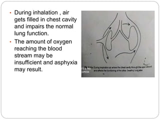 • During inhalation , air
gets filled in chest cavity
and impairs the normal
lung function.
• The amount of oxygen
reaching the blood
stream may be
insufficient and asphyxia
may result.
 