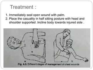 Treatment :
1. Immediately seal open wound with palm.
2. Place the casuality in half sitting posture with head and
shoulder supported .Incline body towards injured side .
 