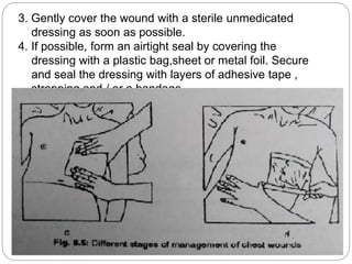 3. Gently cover the wound with a sterile unmedicated
dressing as soon as possible.
4. If possible, form an airtight seal by covering the
dressing with a plastic bag,sheet or metal foil. Secure
and seal the dressing with layers of adhesive tape ,
strapping and / or a bandage
 