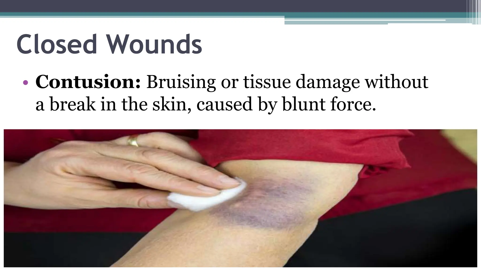 WOUNDS, wound healing process types of wounds.pptx | Death, Injury, or ...