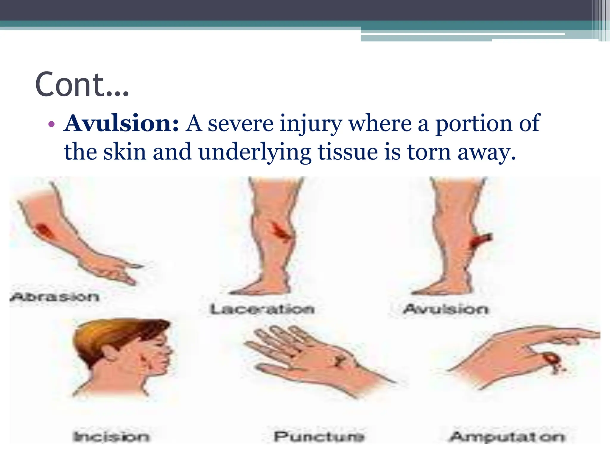 Cont…
• Avulsion: A severe injury where a portion of
the skin and underlying tissue is torn away.
 