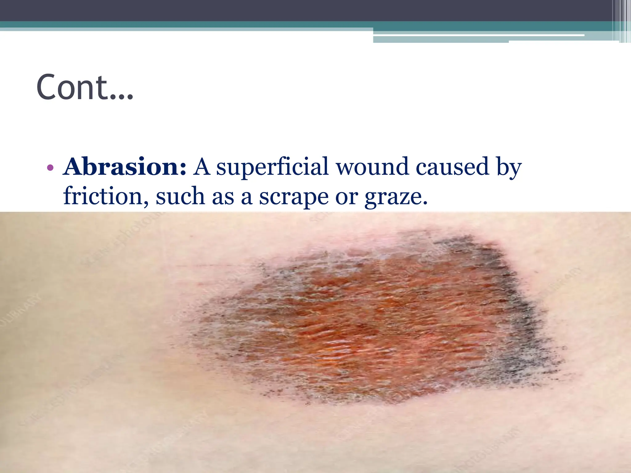 Cont…
• Abrasion: A superficial wound caused by
friction, such as a scrape or graze.
 