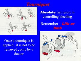 Tourniquet
Absolute last resort in
controlling bleeding
Remember - Life or
limb
Once a tourniquet is
applied, it is not to be
removed , only by a
doctor
 
