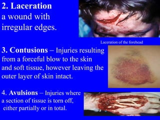 2. Laceration
a wound with
irregular edges.
Laceration of the forehead
3. Contusions – Injuries resulting
from a forceful blow to the skin
and soft tissue, however leaving the
outer layer of skin intact.
4. Avulsions – Injuries where
a section of tissue is torn off,
either partially or in total.
 