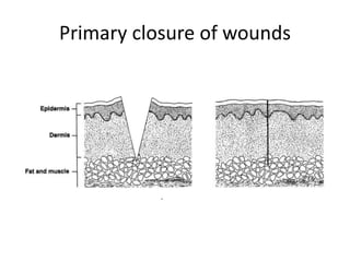 Wounds And wound dressing (Advanced Nursing I) .pptx