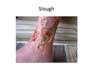 Wounds And wound dressing (Advanced Nursing I) .pptx