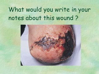 What would you write in your notes about this wound ? 