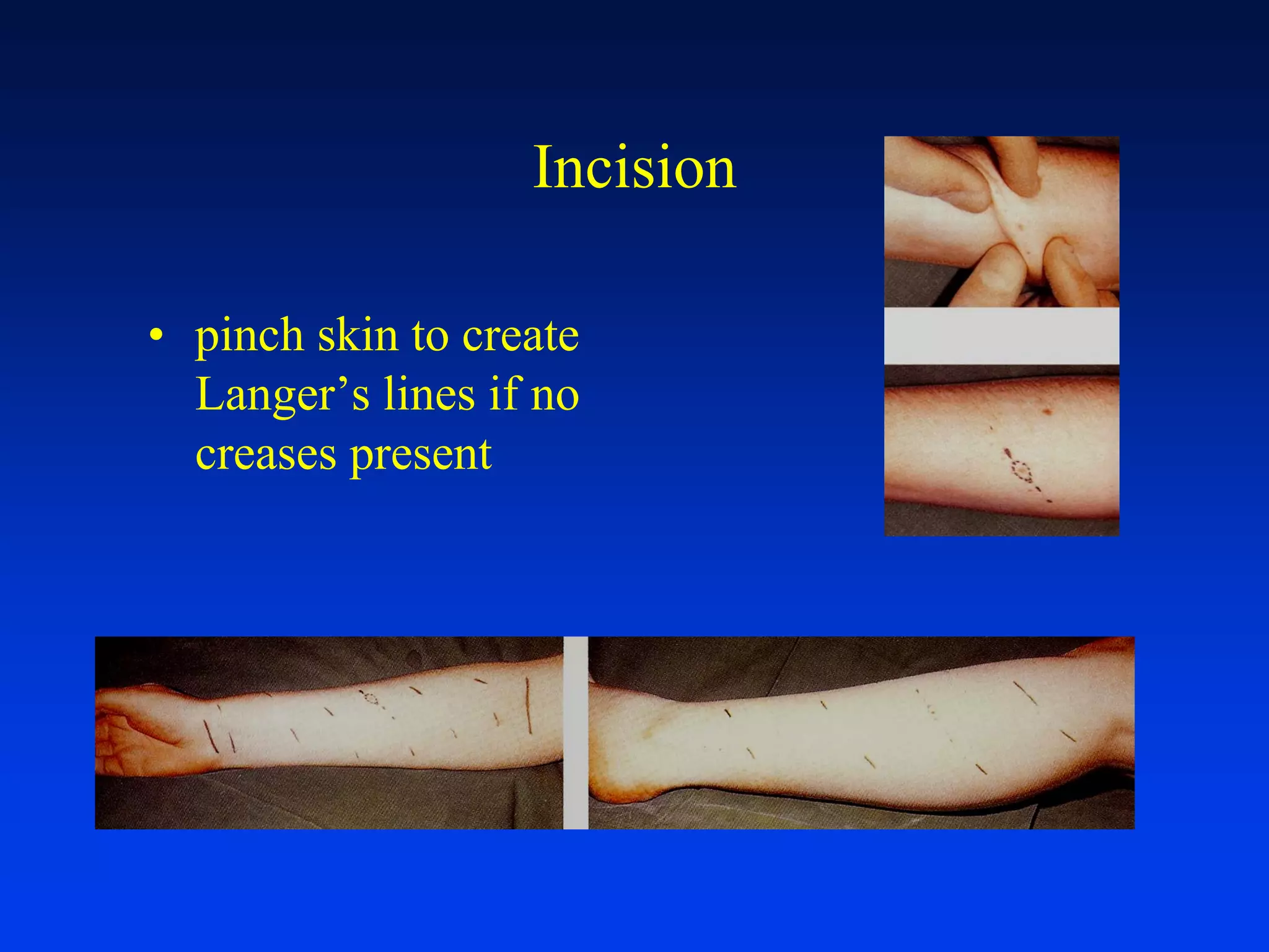 Wound Suturing & Skin Flaps May11 | PDF