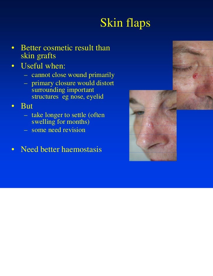 Wound Suturing & Skin Flaps May11