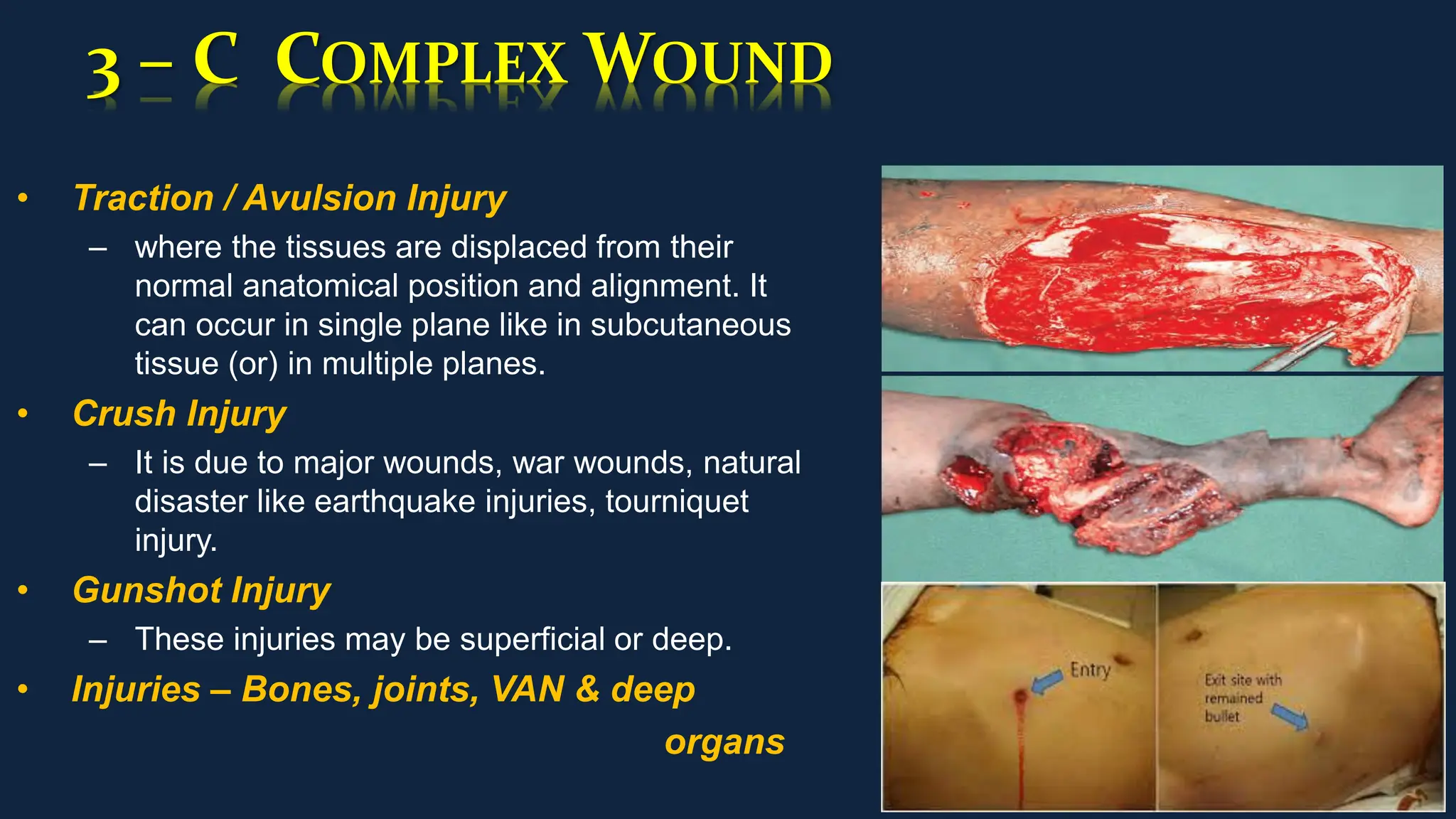 3 – C COMPLEX WOUND
• Traction / Avulsion Injury
– where the tissues are displaced from their
normal anatomical position and alignment. It
can occur in single plane like in subcutaneous
tissue (or) in multiple planes.
• Crush Injury
– It is due to major wounds, war wounds, natural
disaster like earthquake injuries, tourniquet
injury.
• Gunshot Injury
– These injuries may be superficial or deep.
• Injuries – Bones, joints, VAN & deep
organs
 