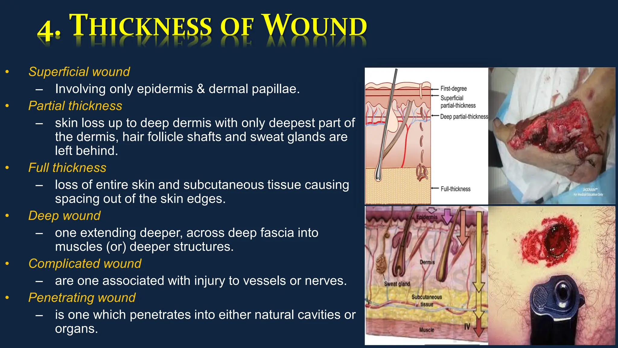 4. THICKNESS OF WOUND
• Superficial wound
– Involving only epidermis & dermal papillae.
• Partial thickness
– skin loss up to deep dermis with only deepest part of
the dermis, hair follicle shafts and sweat glands are
left behind.
• Full thickness
– loss of entire skin and subcutaneous tissue causing
spacing out of the skin edges.
• Deep wound
– one extending deeper, across deep fascia into
muscles (or) deeper structures.
• Complicated wound
– are one associated with injury to vessels or nerves.
• Penetrating wound
– is one which penetrates into either natural cavities or
organs.
 