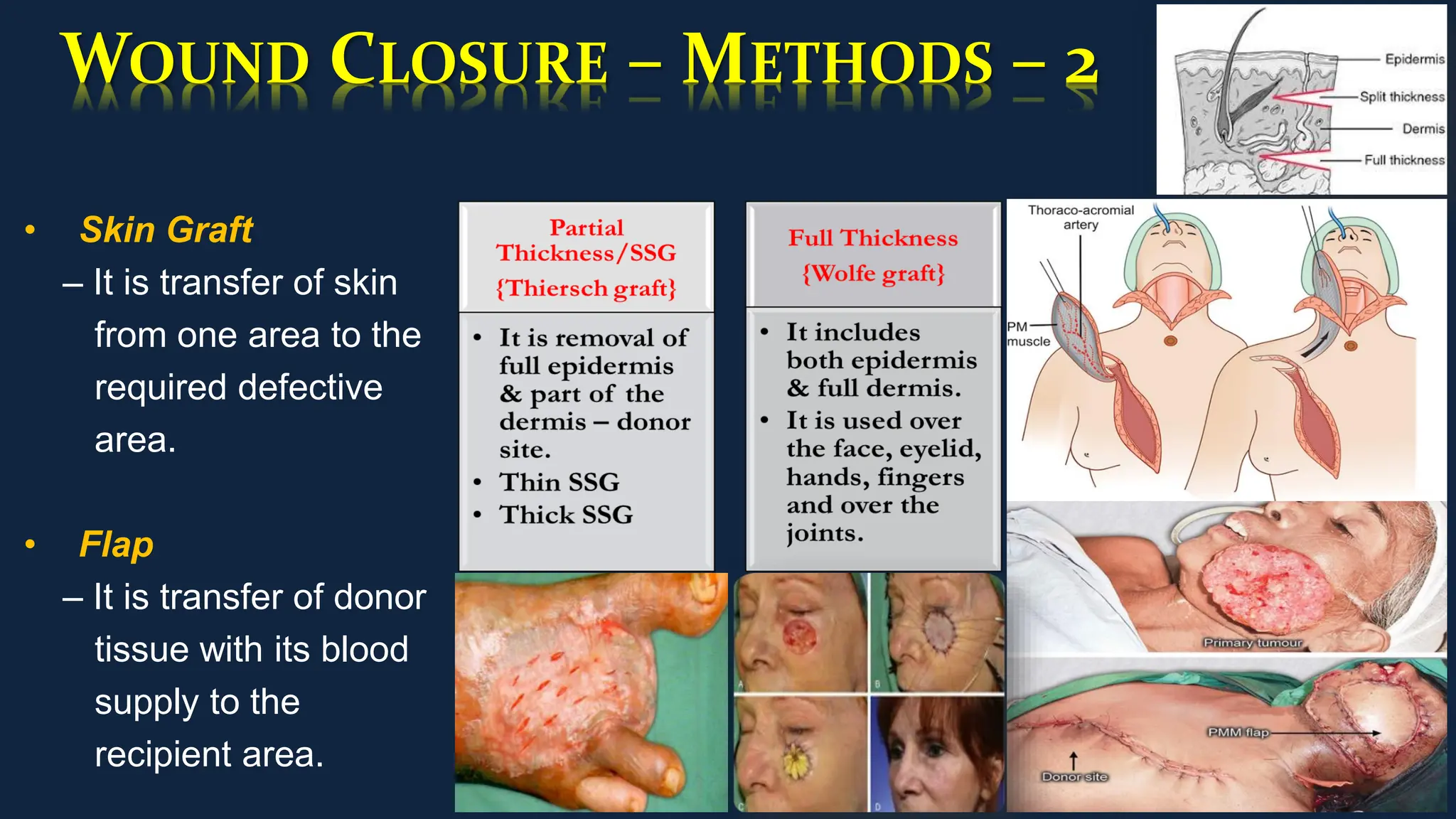 WOUND CLOSURE – METHODS – 2
• Skin Graft
– It is transfer of skin
from one area to the
required defective
area.
• Flap
– It is transfer of donor
tissue with its blood
supply to the
recipient area.
 
