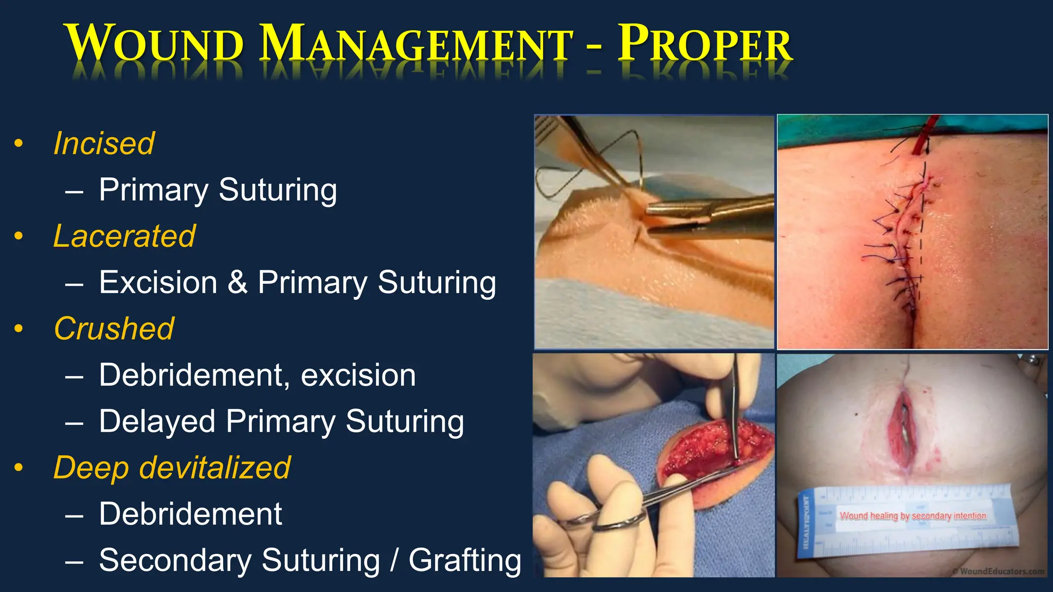 WOUND MANAGEMENT - PROPER
• Incised
– Primary Suturing
• Lacerated
– Excision & Primary Suturing
• Crushed
– Debridement, excision
– Delayed Primary Suturing
• Deep devitalized
– Debridement
– Secondary Suturing / Grafting
 
