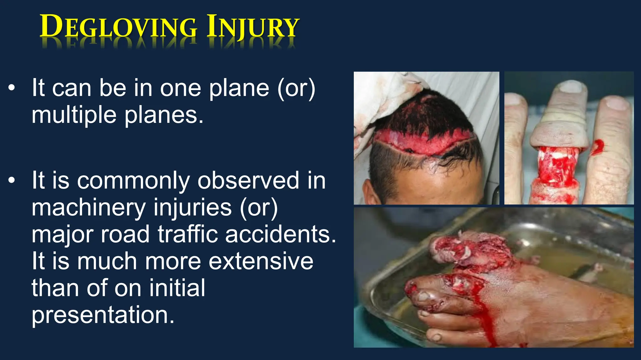 DEGLOVING INJURY
• It can be in one plane (or)
multiple planes.
• It is commonly observed in
machinery injuries (or)
major road traffic accidents.
It is much more extensive
than of on initial
presentation.
 