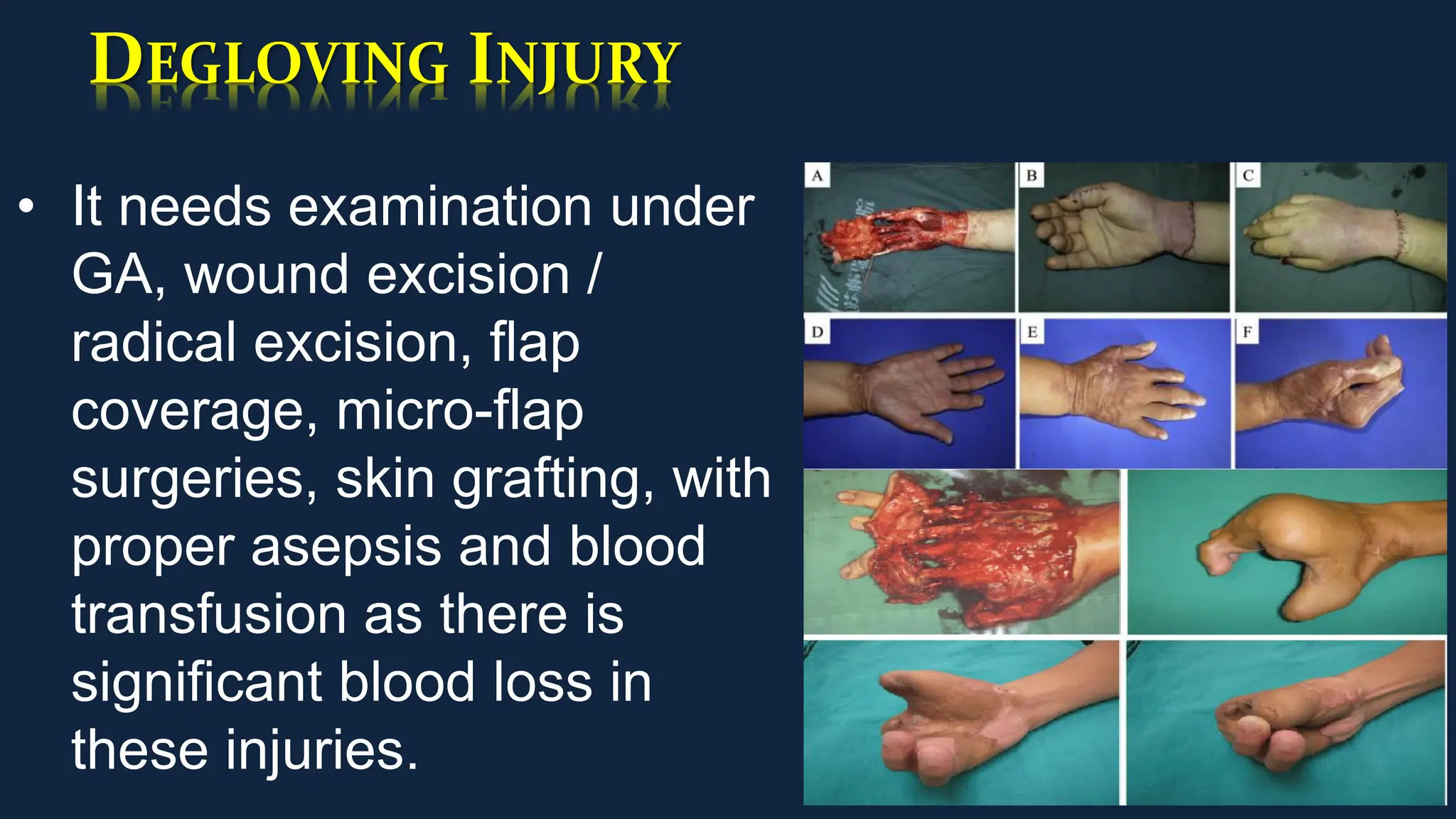 DEGLOVING INJURY
• It needs examination under
GA, wound excision /
radical excision, flap
coverage, micro-flap
surgeries, skin grafting, with
proper asepsis and blood
transfusion as there is
significant blood loss in
these injuries.
 