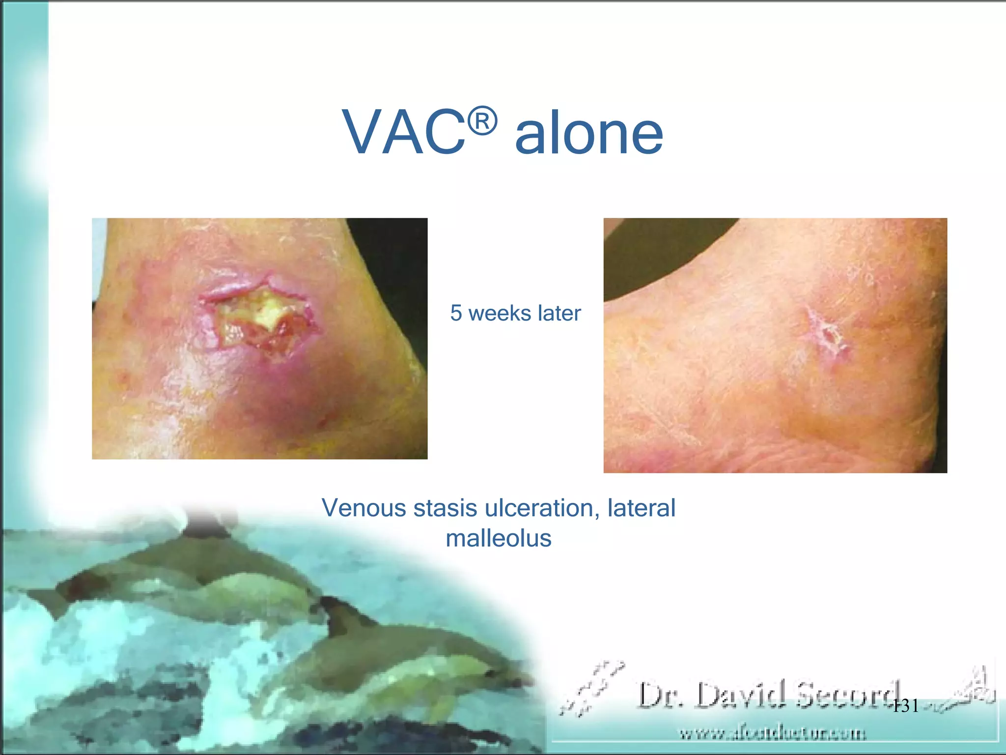 Wound Vac Lecture