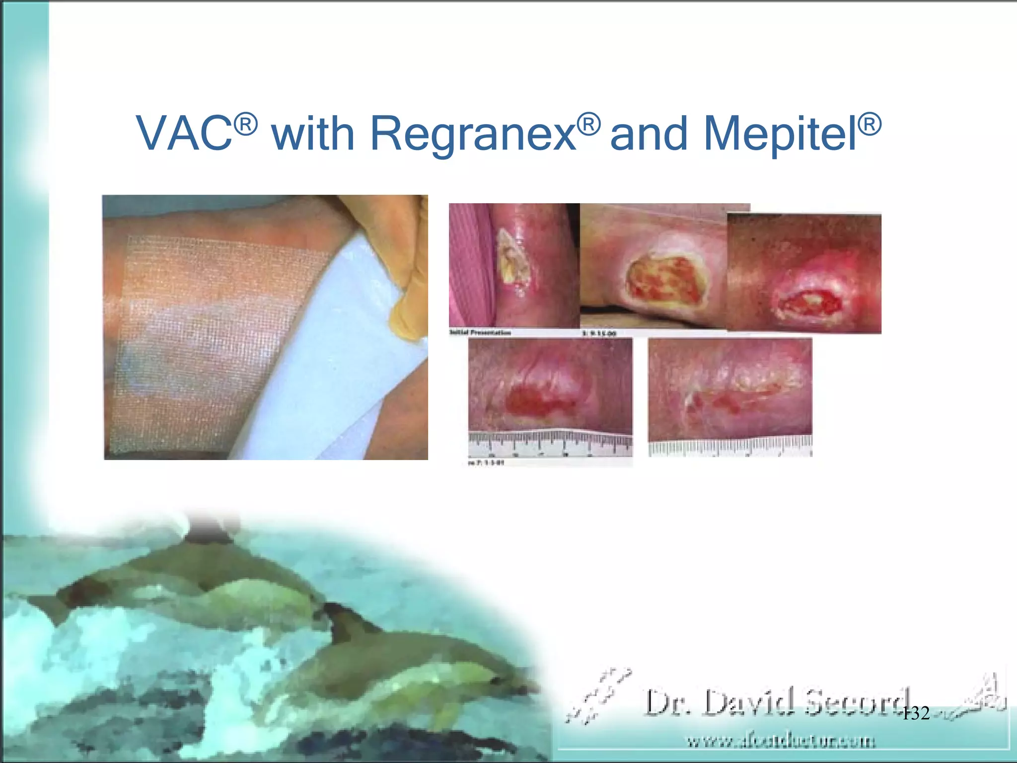Wound Vac Lecture