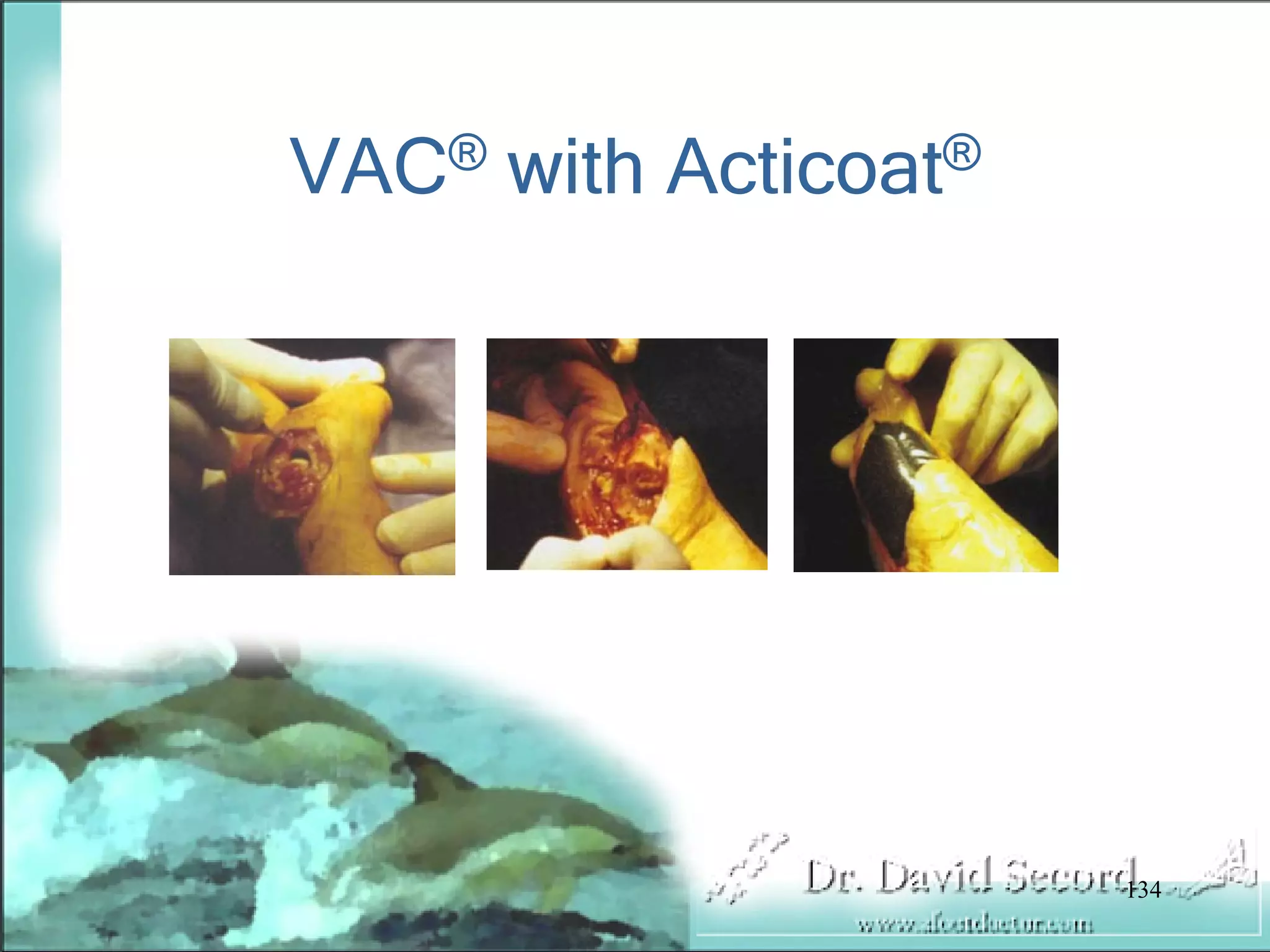 Wound Vac Lecture