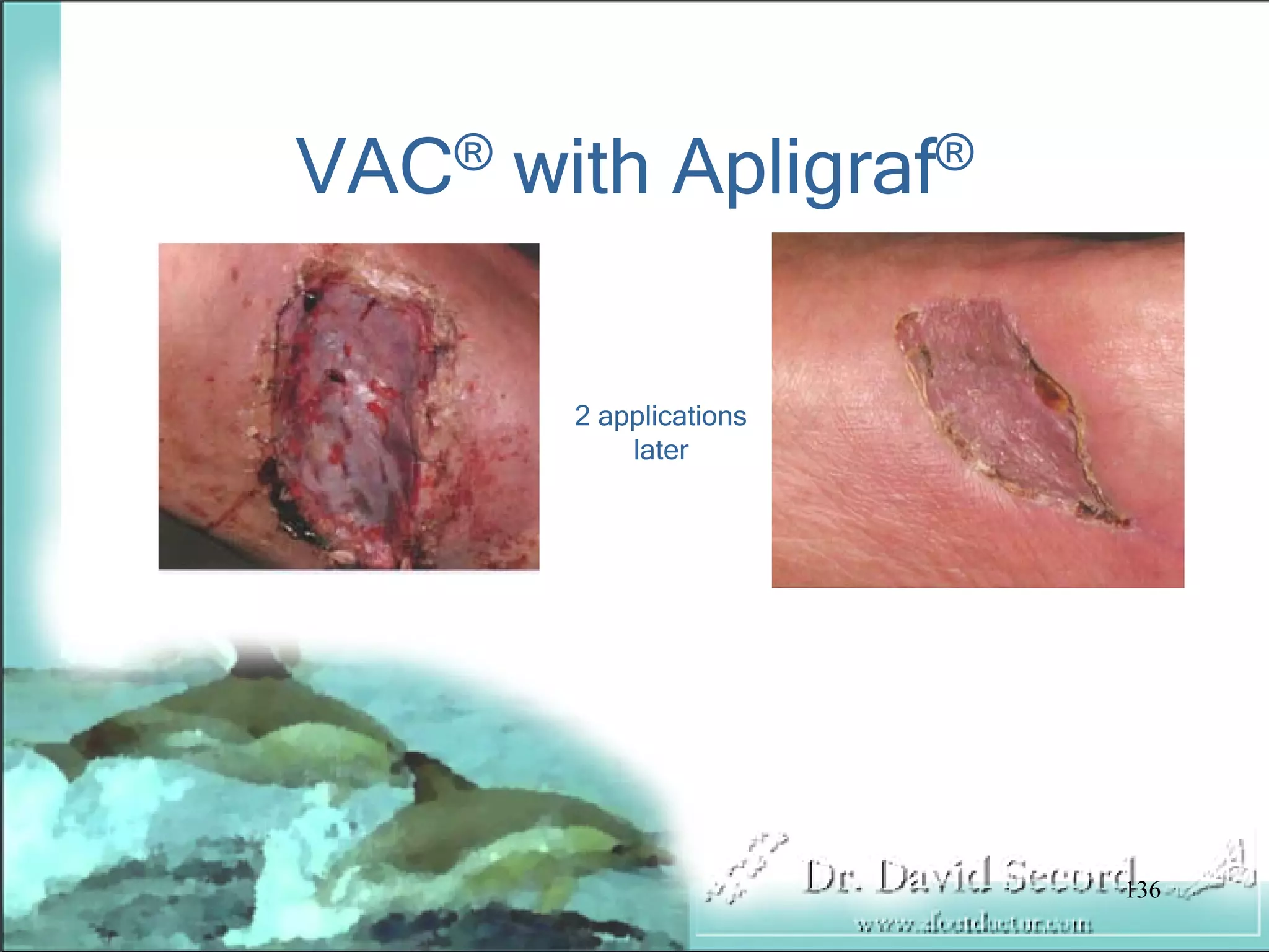 Wound Vac Lecture