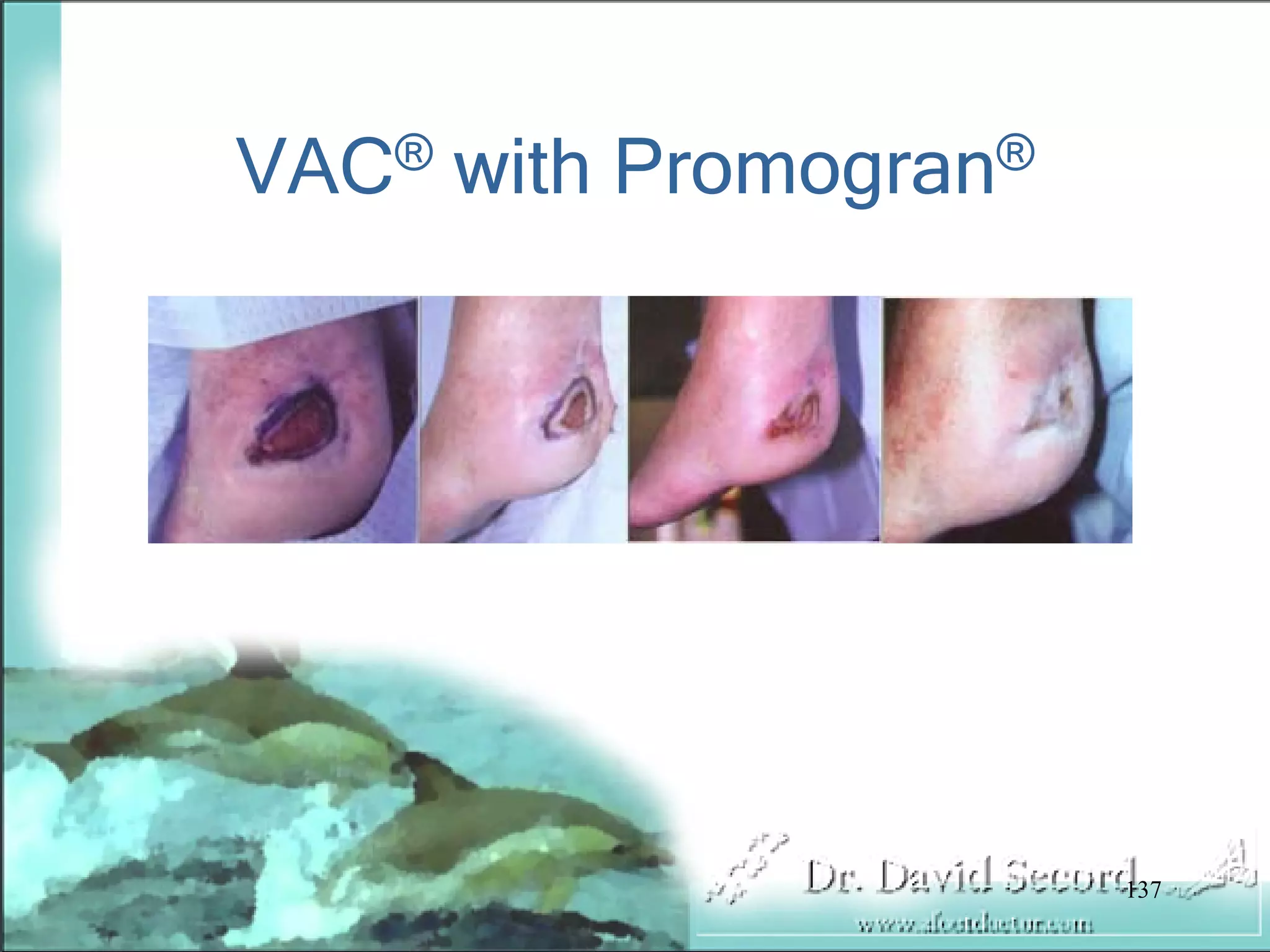 Wound Vac Lecture