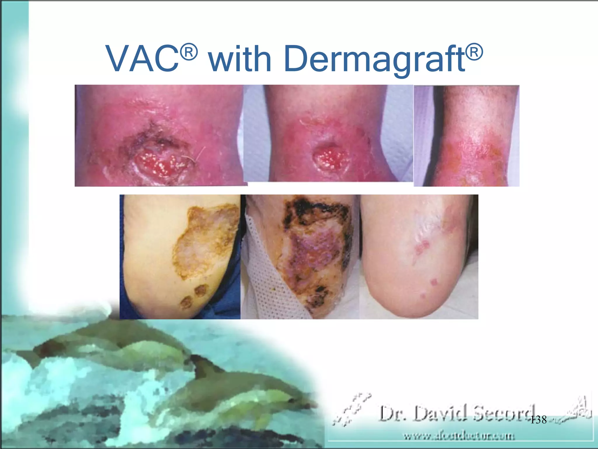 Wound Vac Lecture