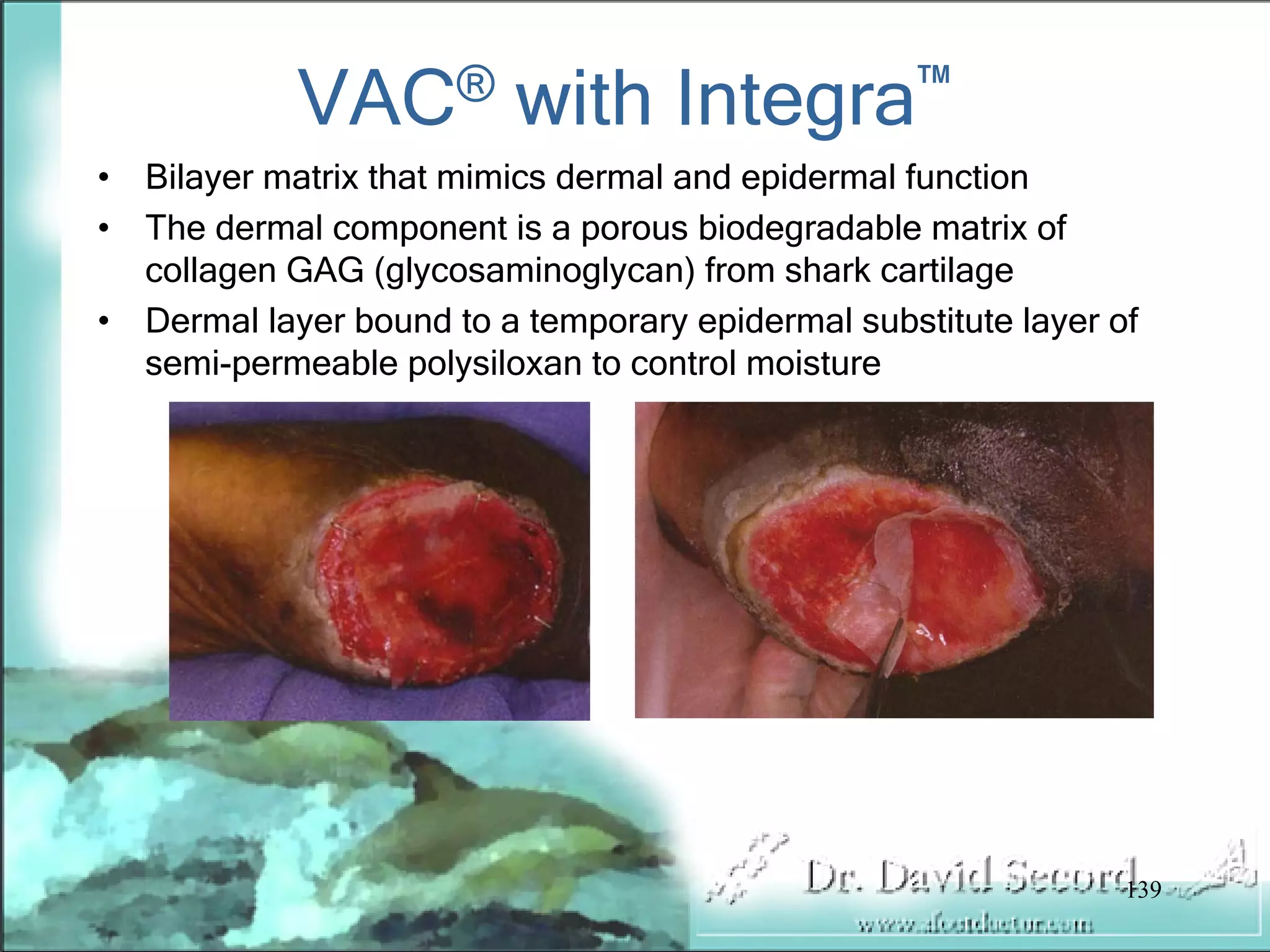 Wound Vac Lecture