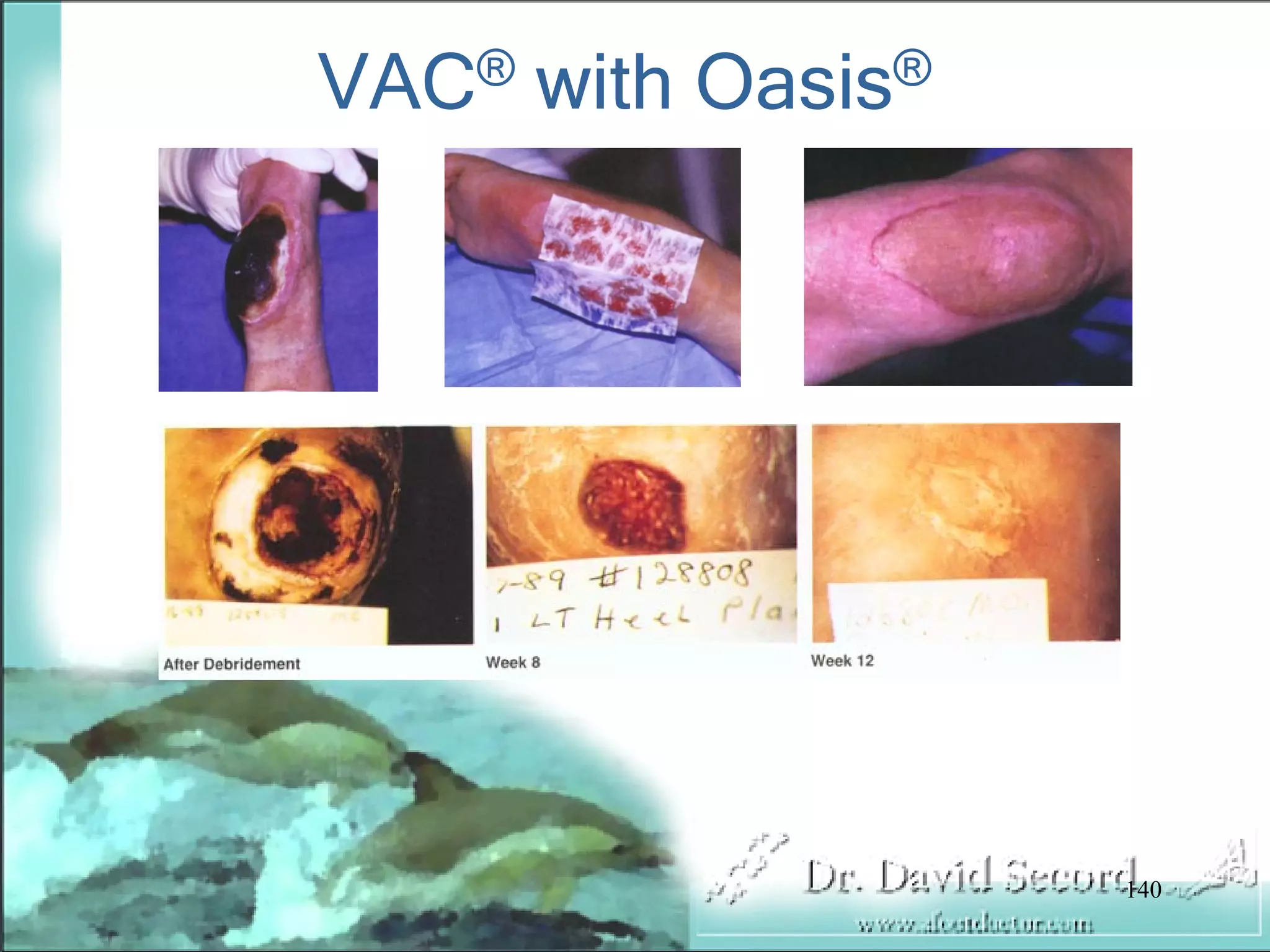 Wound Vac Lecture