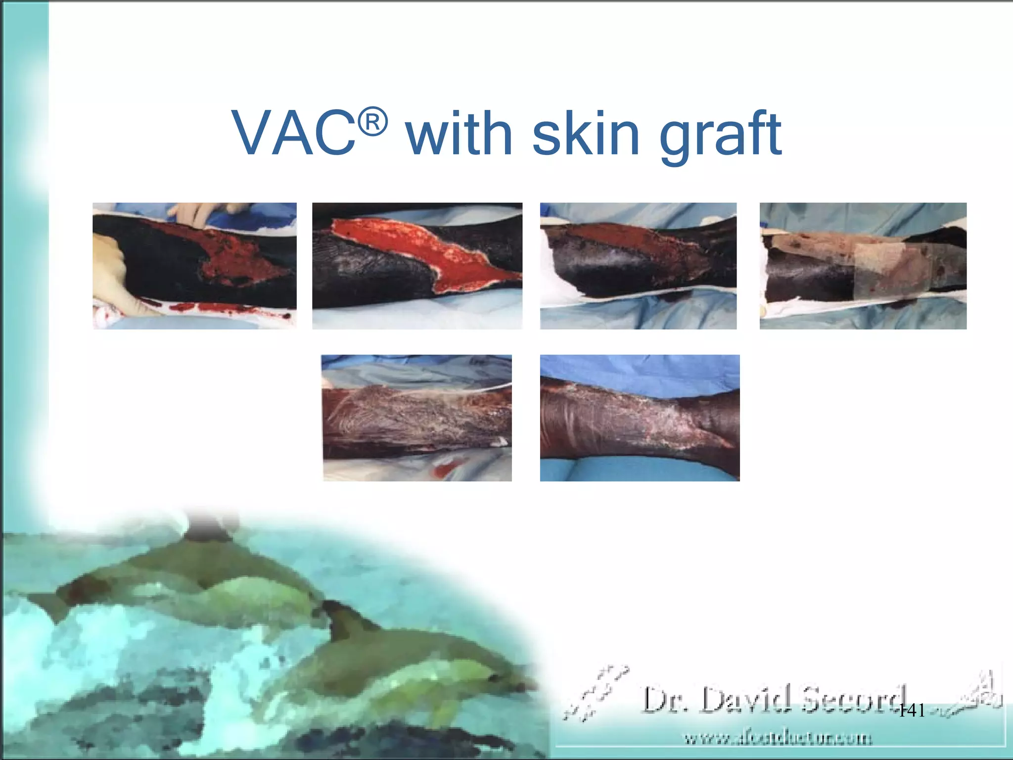 Wound Vac Lecture