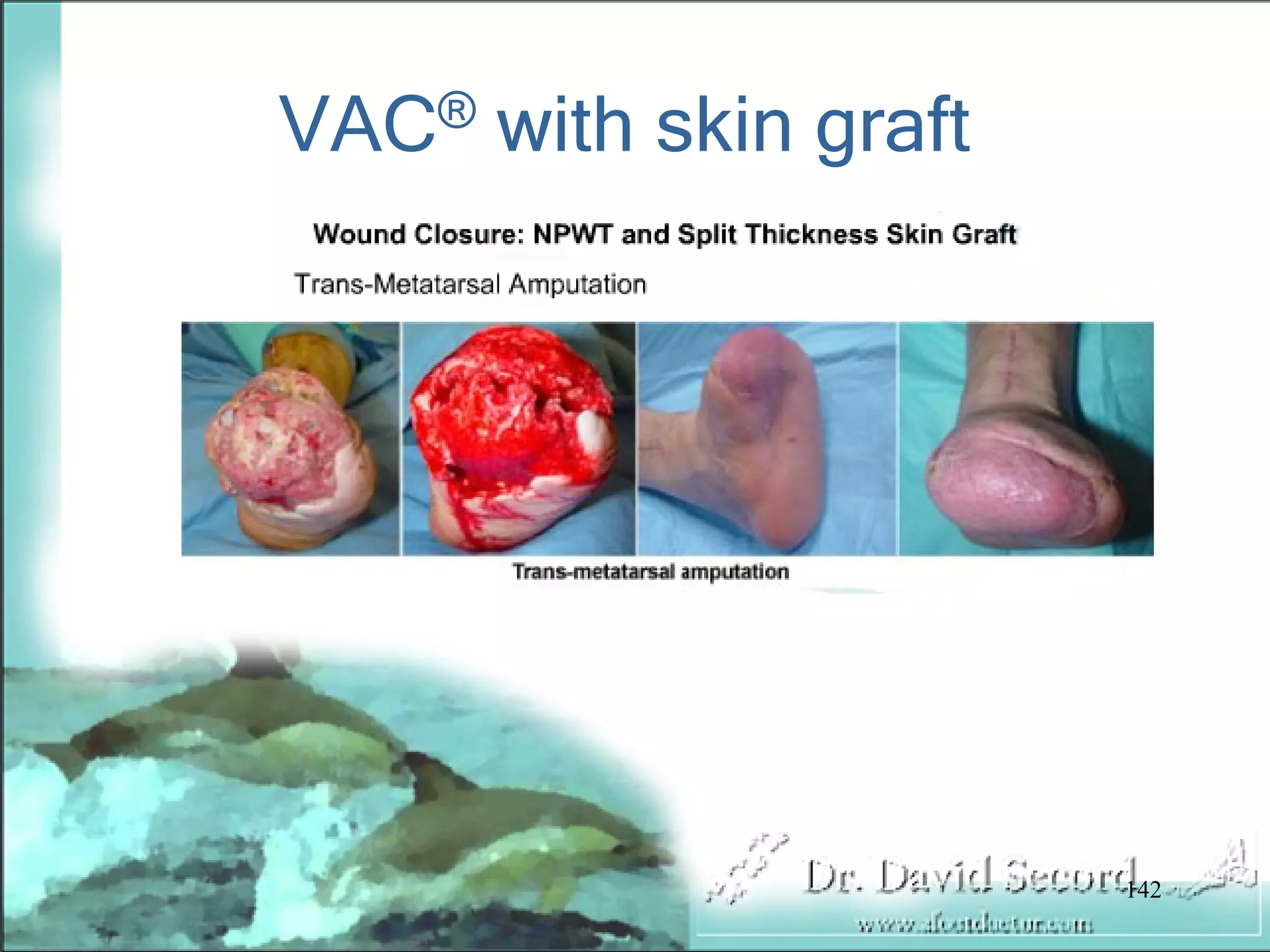 Wound Vac Lecture
