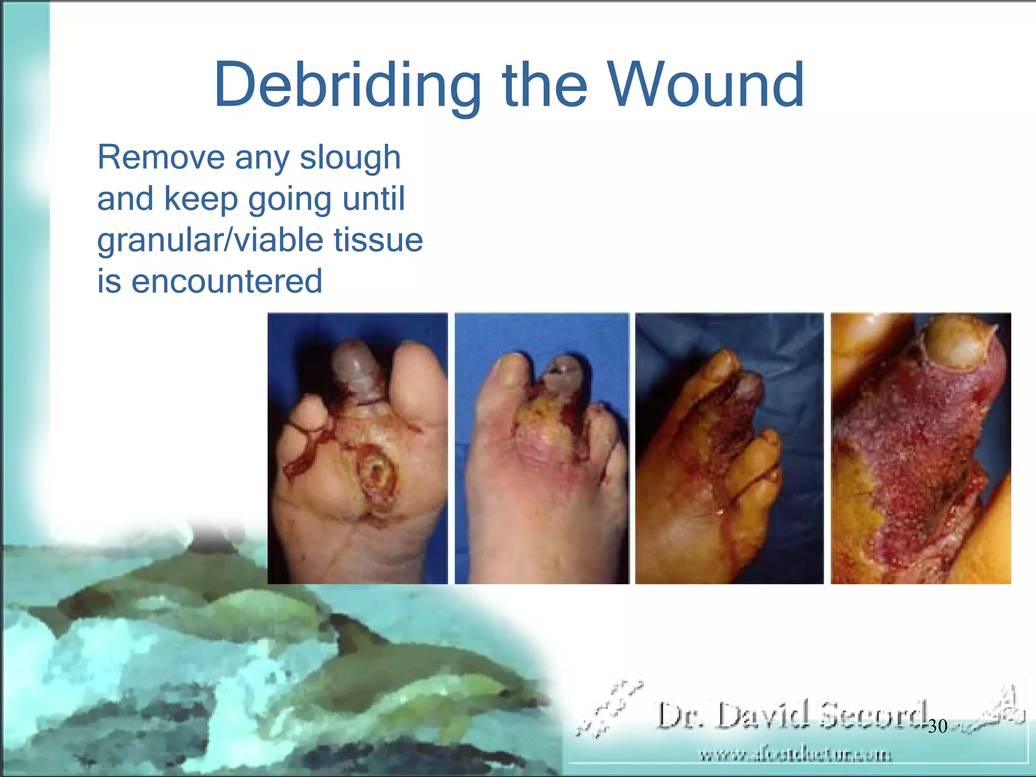 Wound Vac Lecture