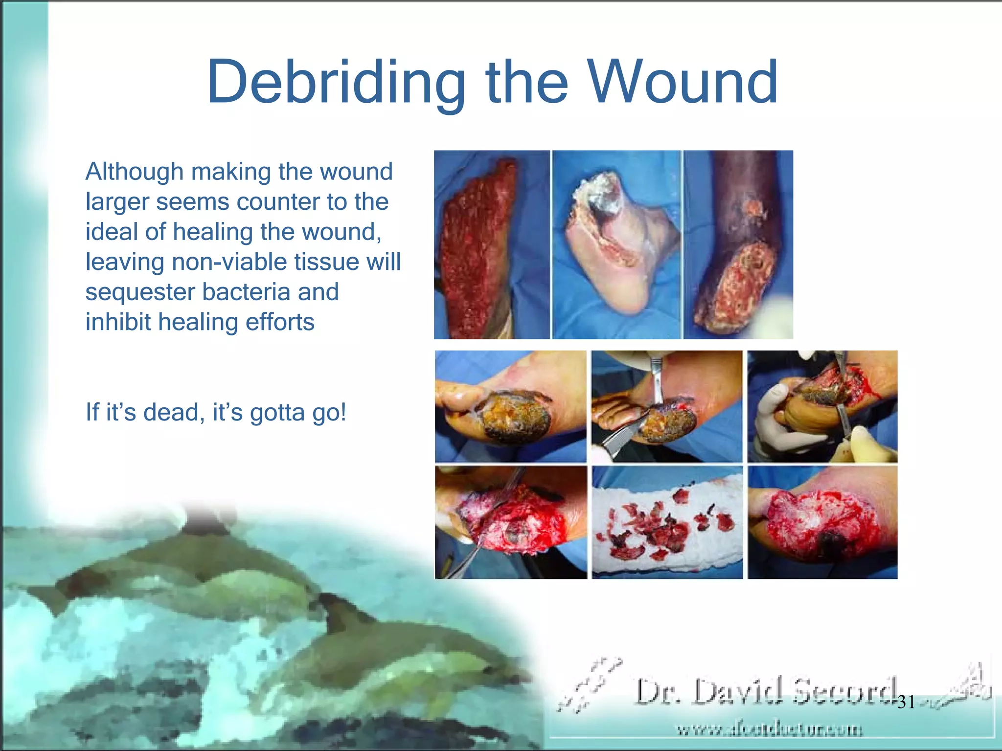 Wound Vac Lecture