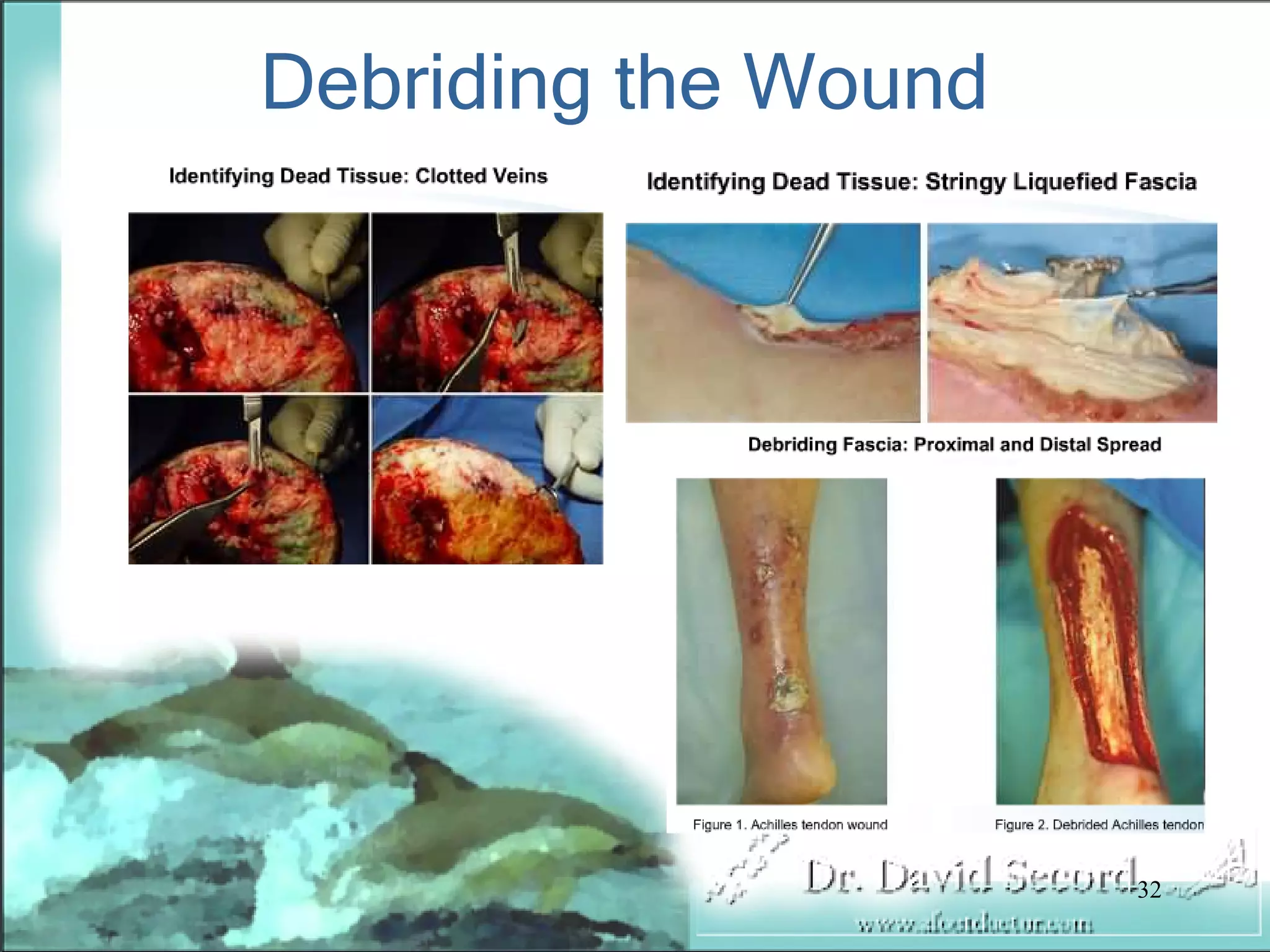 Wound Vac Lecture