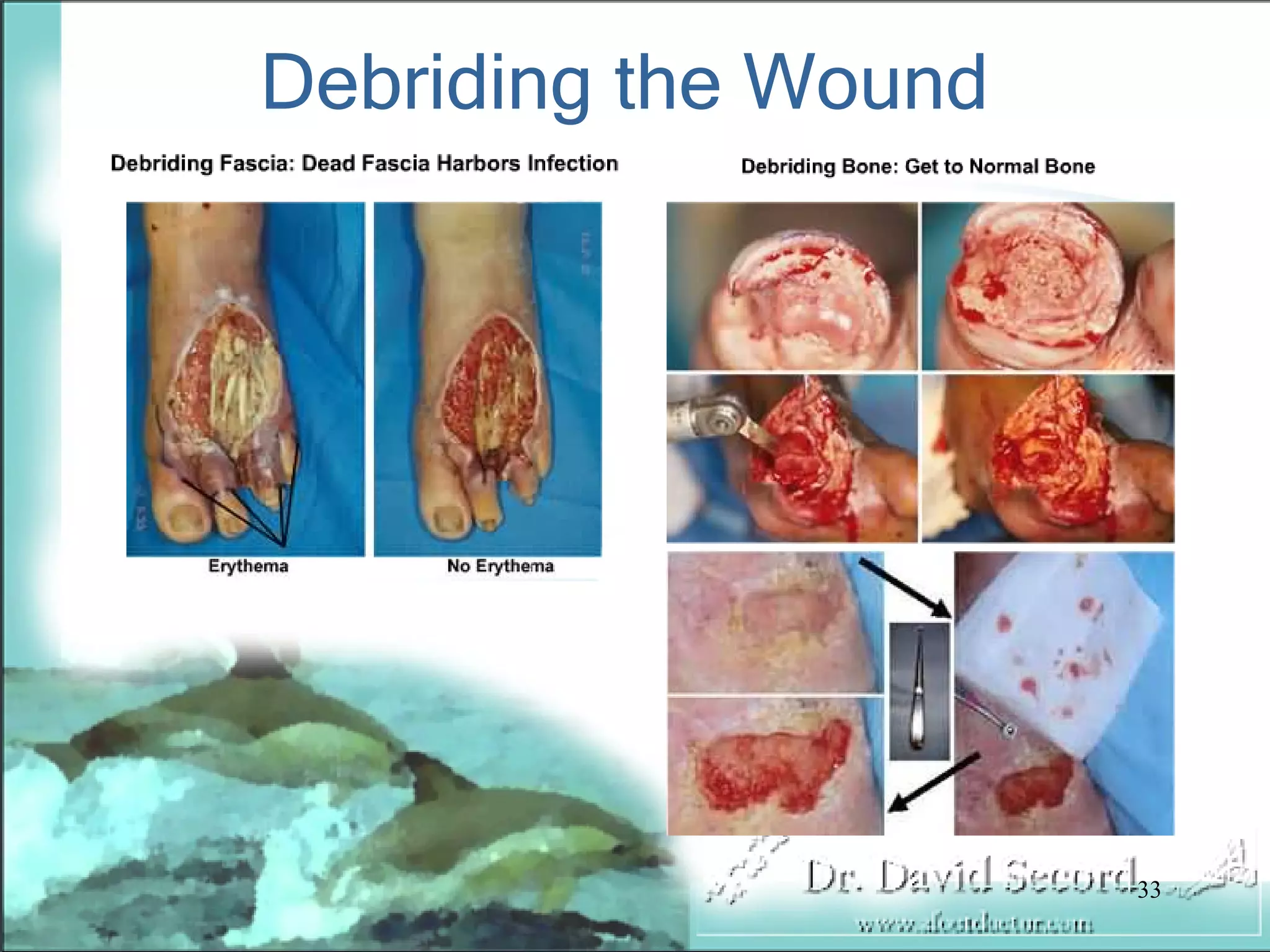 Wound Vac Lecture