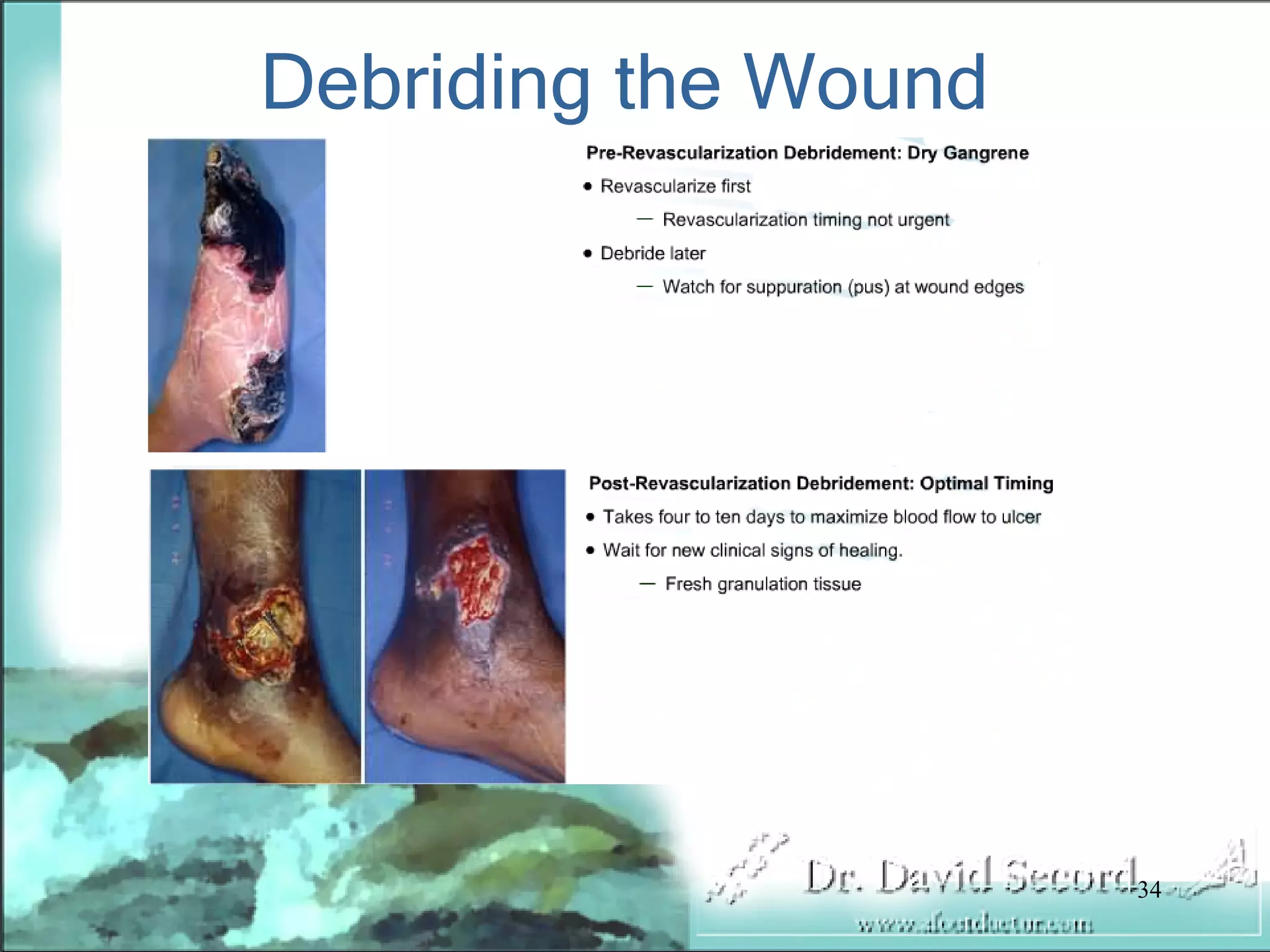 Wound Vac Lecture